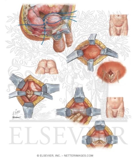Watermarked preview of unlabeled image: Seminal Vesicle: Surgical Approaches