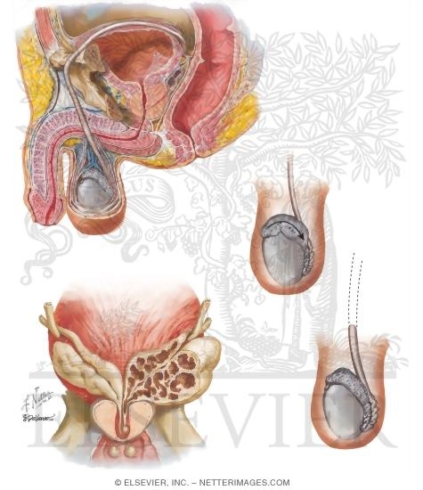 Azoospermia II: Excurrent Duct Obstruction