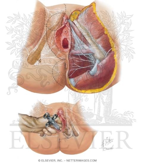 Watermarked preview of unlabeled image: Innervation of External Genitalia, Perineum