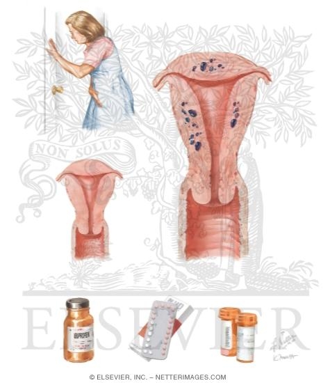 Watermarked preview of unlabeled image: Adenomyosis