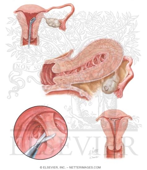 Asherman's Syndrome