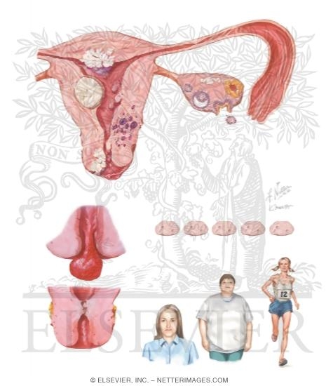 Watermarked preview of unlabeled image: Female Infertility I: Causes