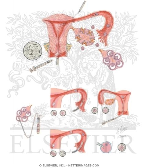 Watermarked preview of unlabeled image: Assisted Reproduction