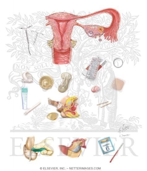 Watermarked preview of unlabeled image: Contraception