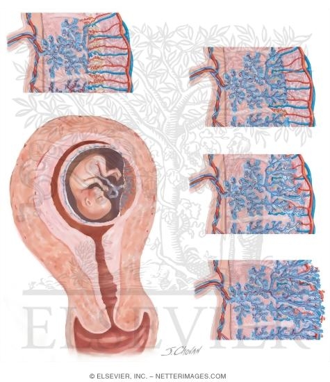 Плацента на рубце матки