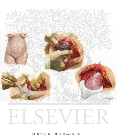 Cesarean Delivery