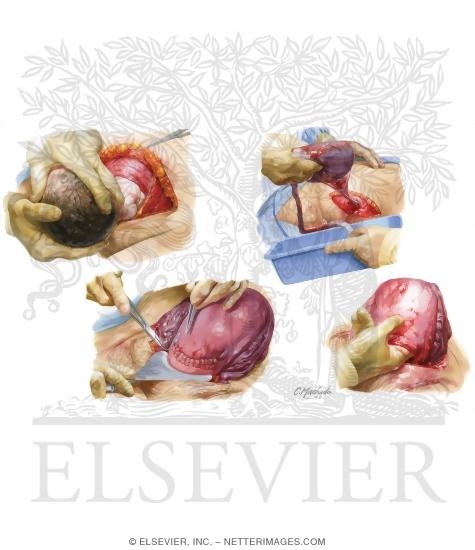 Cesarean Delivery