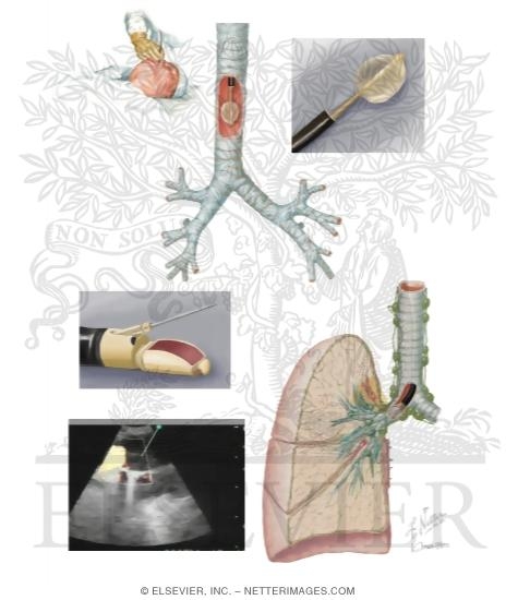 Endobronchial Ultrasonography