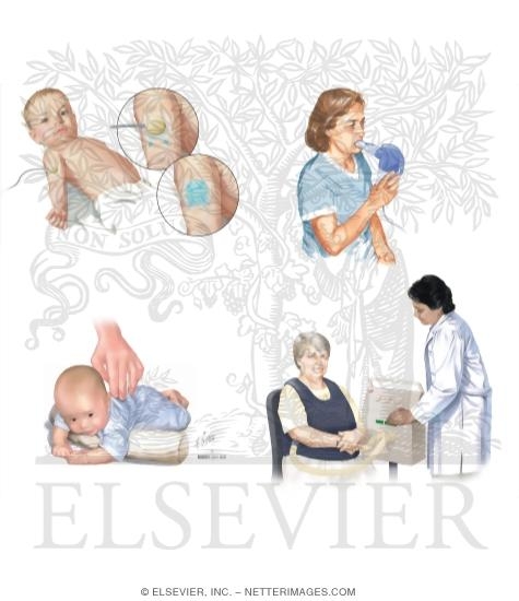 Watermarked preview of unlabeled image: Cystic Fibrosis: Testing and Treatment