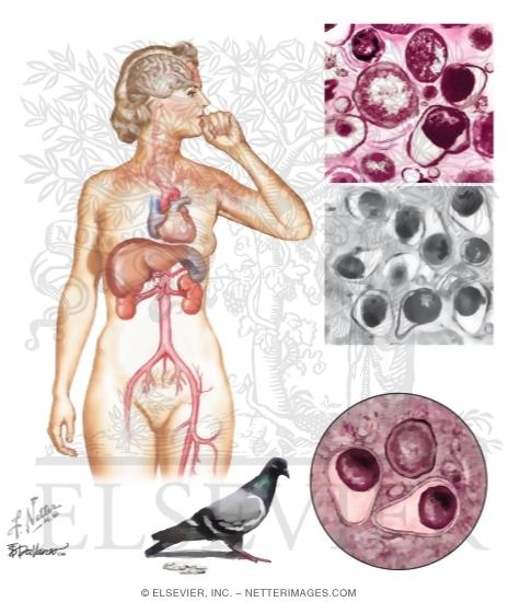 Atypical Pathogen Pneumonia: Chlamydophilia
