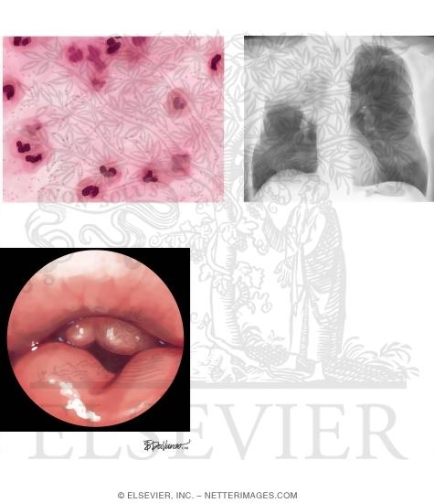 Watermarked preview of unlabeled image: Hemophilus Influenza Pneumonia