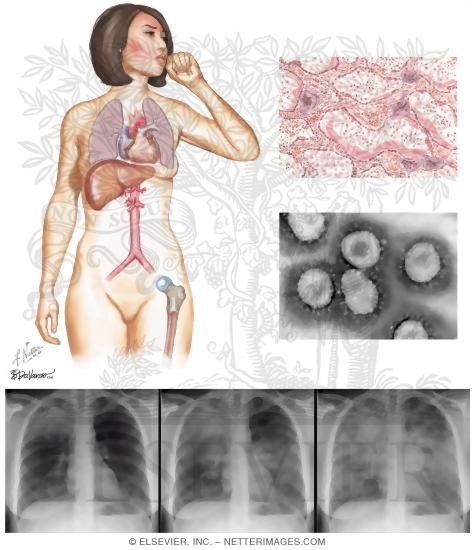 Viral CAP: SARS