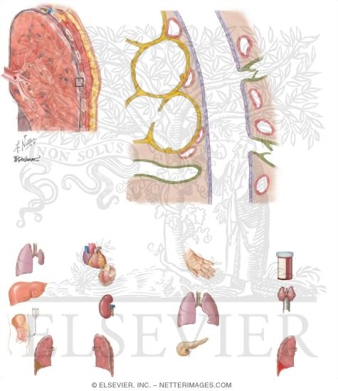 Watermarked preview of unlabeled image: Pathophysiology of Pleural Fluid Accumulation