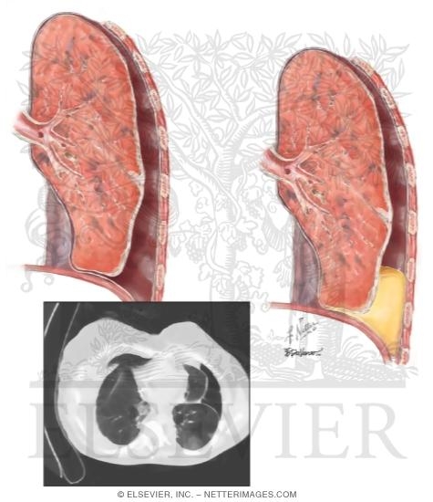 Watermarked preview of unlabeled image: Unexpandable Lung