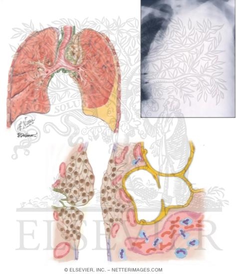 Malignancy In Pleural Effusion