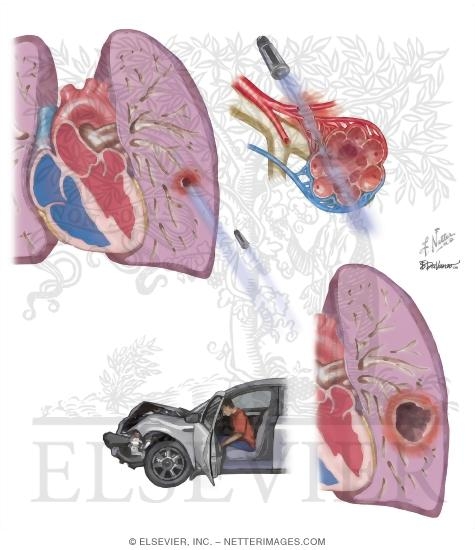 Pulmonary Laceration