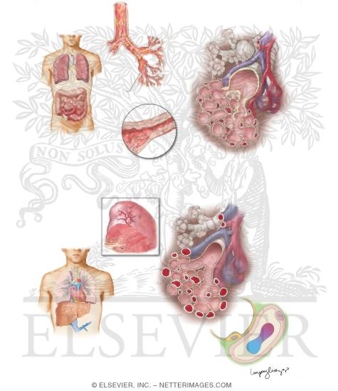 Watermarked preview of unlabeled image: Pulmonary Manifestations of Inflammatory Bowel Disease (IBD) and Liver Disease