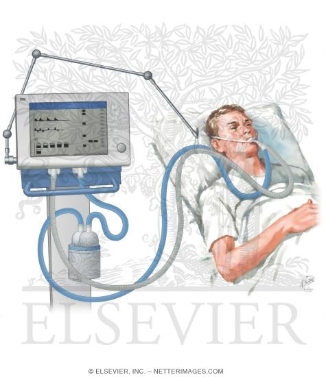 Mechanical Ventilation