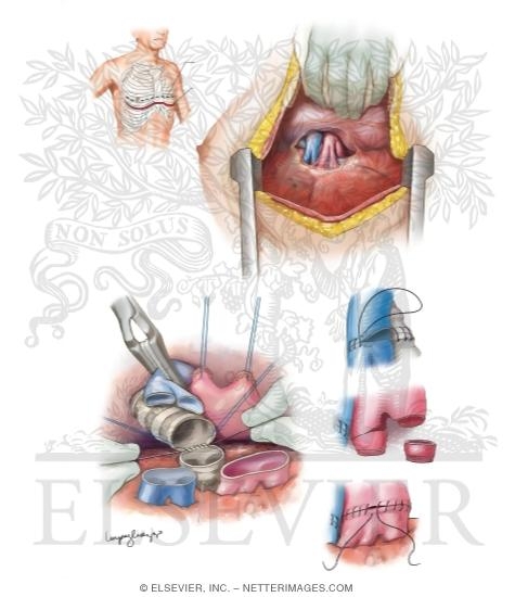 Watermarked preview of unlabeled image: Lung Transplant