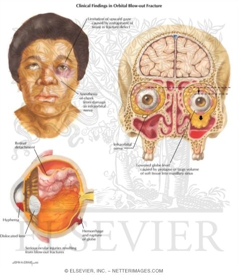 Clinical Findings In Orbital Blow-Out Fracture