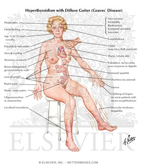 Hyperthyroidism With Diffuse Goiter (Graves' Disease)