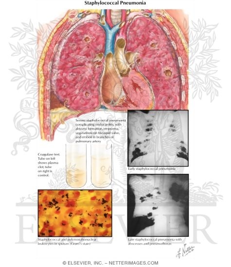Staphylococcal Pneumonia