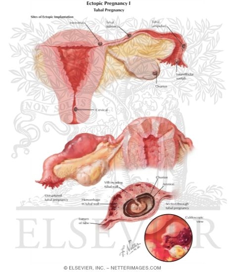 Watermarked preview of labeled image: Ectopic Pregnancy