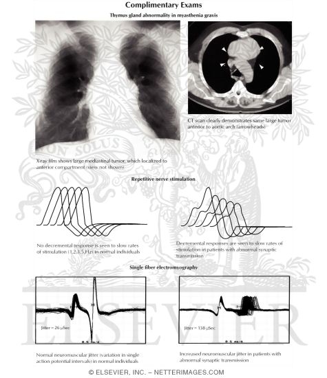 Complimentary Exams: Thymus Gland Abnormality In Myasthenia Gravis