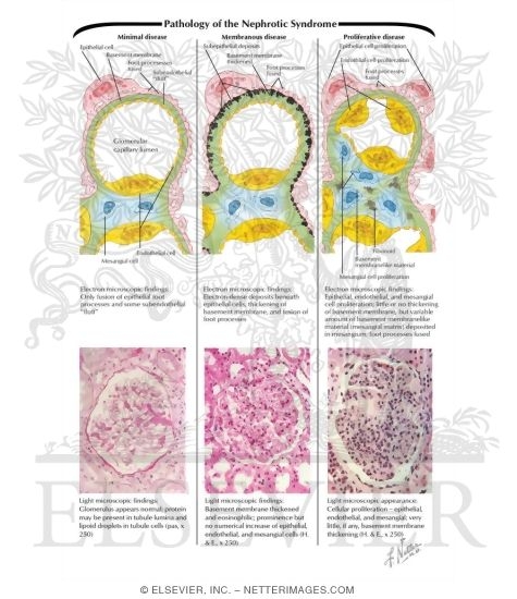 Pathology of the Nephrotic Syndrome