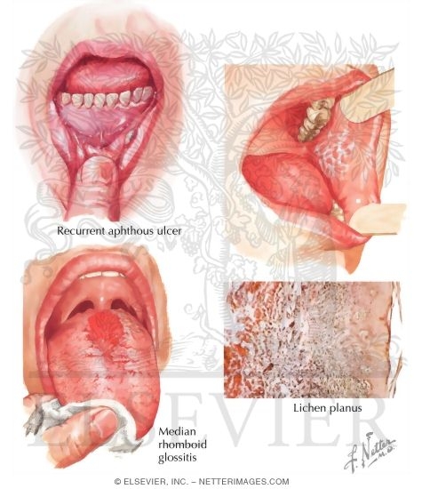 Watermarked preview of labeled image: Common Oral Lesions