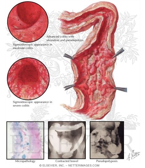 Ulcerative Colitis