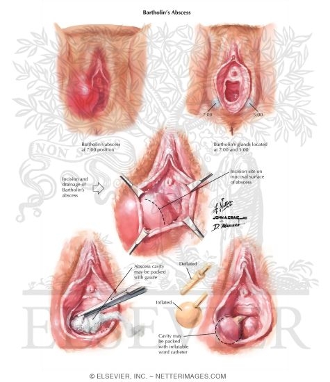 Bartholin's Gland: Abscess and Infection
