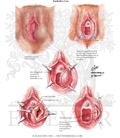 Watermarked preview of labeled image: Bartholin's Gland: Cysts