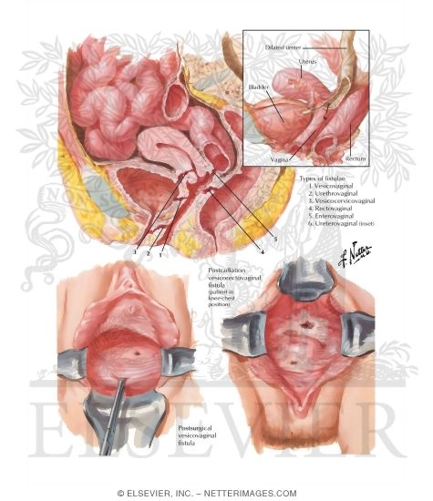 Watermarked preview of labeled image: Fistulae: Gastrointestinal and Urinary Tract