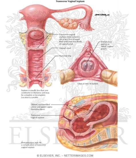 Transverse Vaginal Septum
