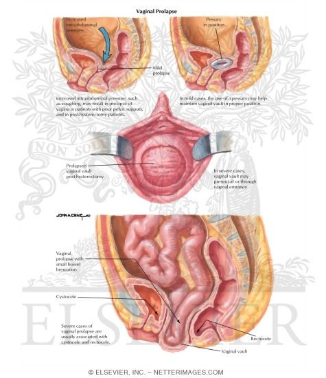 Vaginal Prolapse