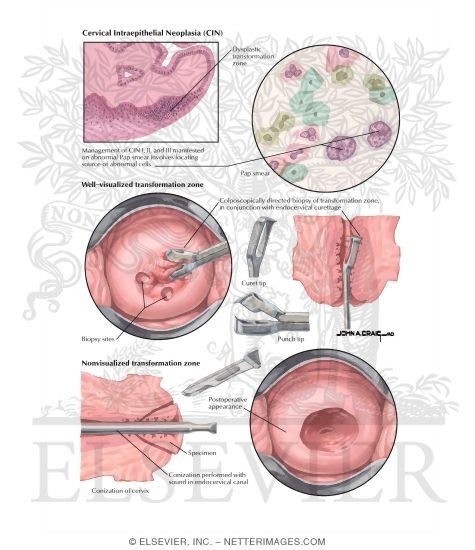 Cervical Intraepithelial Neoplasia
Abnormal Pap Smear: Low and High-Grade Squamous Intraepithelial Lesion