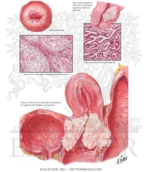 Watermarked preview of labeled image: Cervical Cancer