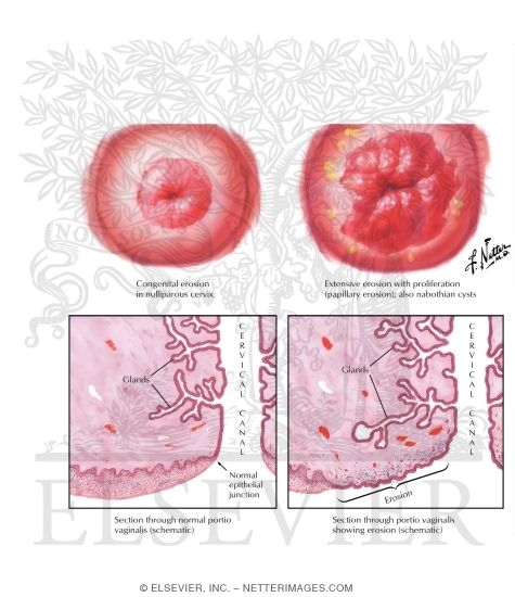 Cervical Erosion