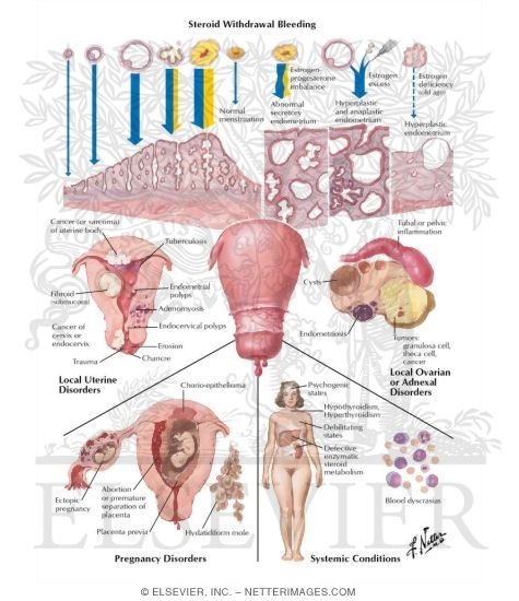 Watermarked preview of labeled image: Functional and Pathological Causes of Uterine Bleeding
Dysfunctional Uterine Bleeding