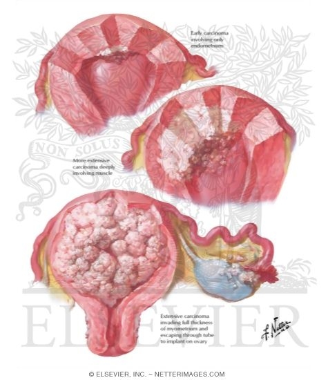Watermarked preview of labeled image: Cancer of Corpus I - Various Stages and Types