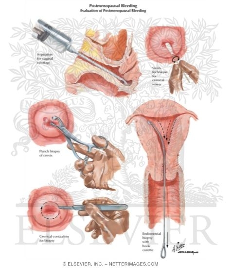 Watermarked preview of labeled image: Postmenopausal Vaginal Bleeding
Evaluation of Postmenopausal Bleeding