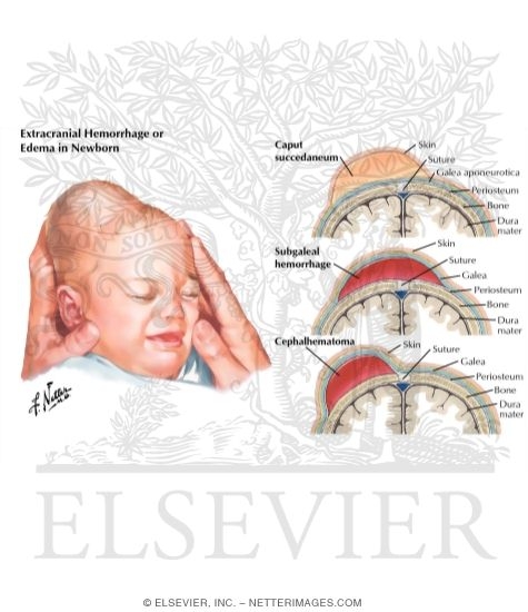 caput succedaneum