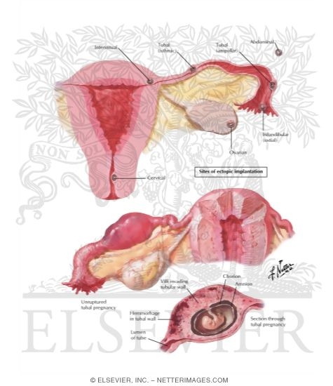 Watermarked preview of labeled image: Ectopic Pregnancy