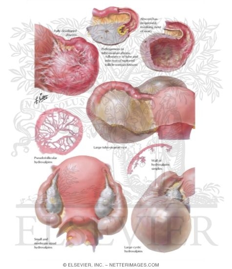 Watermarked preview of labeled image: Hydrosalpinx (Chronic Pelvic Inflammatory Disease)