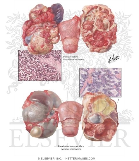 Watermarked preview of labeled image: Carcinoma - Primary Cystic Carcinoma, Primary Solid Carcinoma, Secondary Ovarian Carcinoma