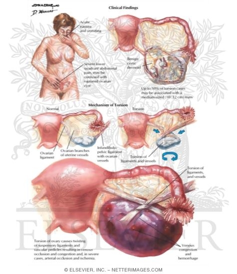 Watermarked preview of labeled image: Ovarian Torsion