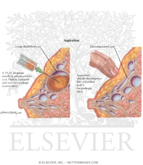 Watermarked preview of labeled image: Breast: Aspiration of Cysts