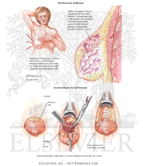 Fat Necrosis of Breast
Breast: Fat Necrosis
Breast: Fat Necrosis/Fat Necrosis of Breast