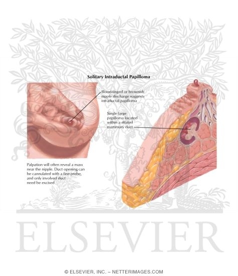 Breast: Intraductal Papilloma
Solitary Intraductal Papilloma